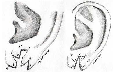 Repair-cracked-or-torn-earlobes
